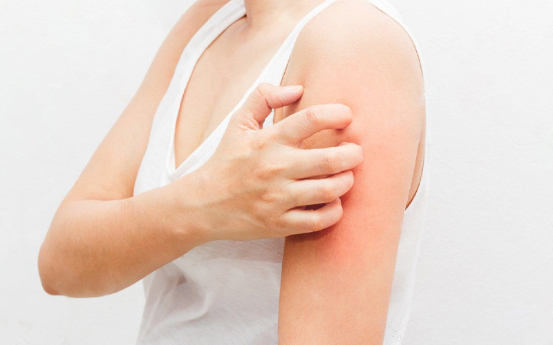 A natural anti-dermatitis remedy