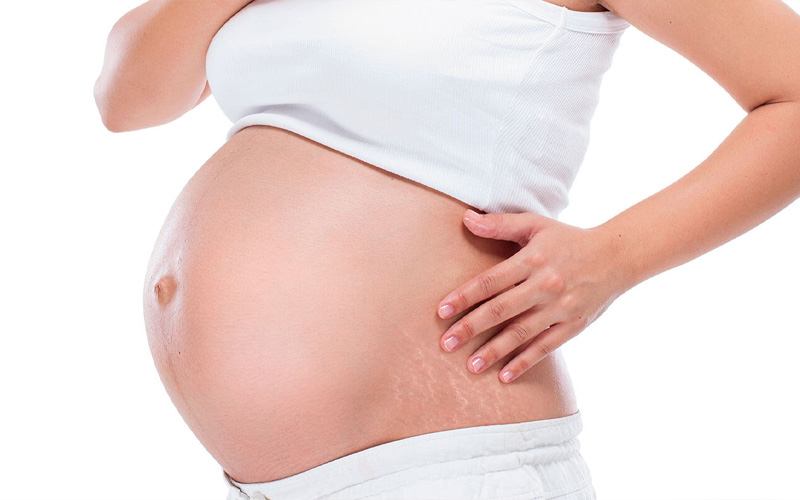 A natural remedy for stretch marks